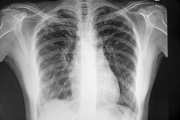 Tuberculose pulmonaire