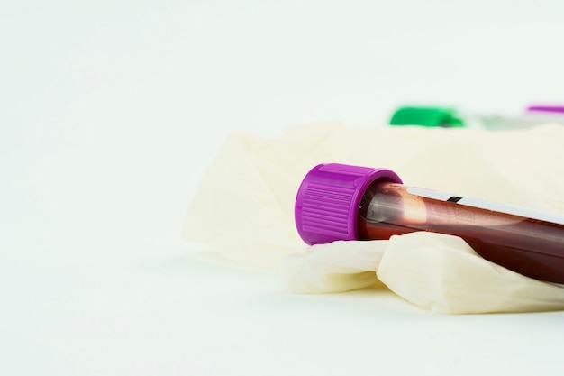 Tubes à vide pour la collecte et les échantillons de sang, une seringue et un gant chirurgical sur fond blanc. Tubes transparents avec couvercle violet et vert. Étiquette pour identifier les données. Mise au point sélective.