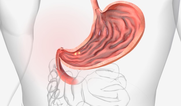 Photo les ulcères gastriques sont des plaies ouvertes qui se développent sur la muqueuse de l'estomac