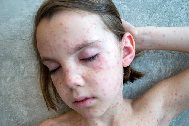 Photo vaccination naturelle maladie contagieuse enfant malade atteint de varicelle