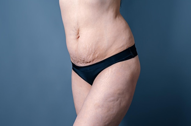Le ventre et les cuisses nues d'une femme après l'accouchement des verrues féminines sur la peau de l'abdomen et des jambes