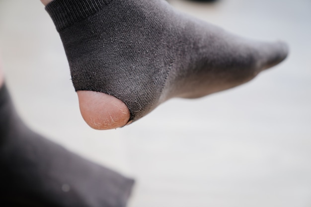 Vieille chaussette trouée sur la jambe.