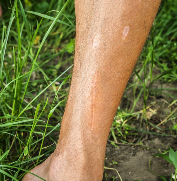 Vieille cicatrice sur la jambe de l'homme. Accident dans le passé.