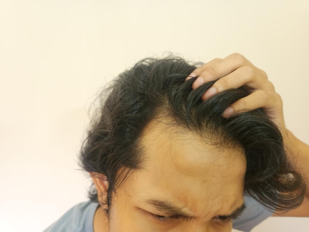 Visage choqué d'un homme asiatique chauve et cheveux perdus sur fond blanc isolé