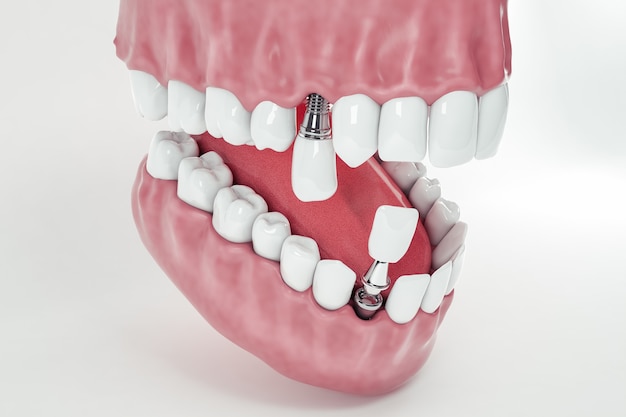 Photo vue de dessus d'un faux implant dentaire fixé dans l'os de la mâchoire ; 3d ; illustration 3d