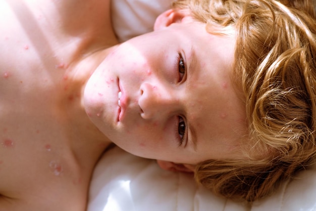 Vue de dessus d'un garçon malade avec des cloques de varicelle sur le visage regardant la caméra et mordant la lèvre tout en se reposant sur le lit à la maison