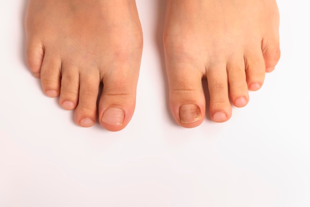 Vue de dessus d'un pied et d'un ongle avec un champignon dessus sur fond blanc