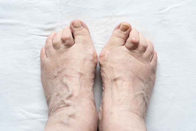 Vue de dessus des pieds féminins avec des orteils en marteau, des ongles cassés et une peau sèche sur fond blanc