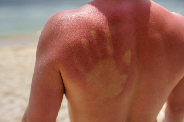 Vue d'un homme avec une peau de coup de soleil à la plage