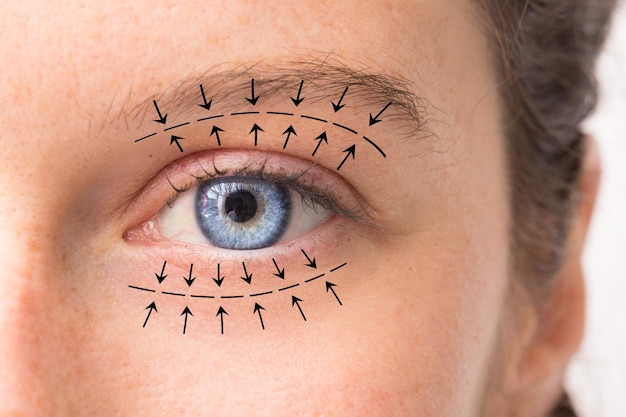 Une vue macro sur le joli œil bleu d'une fille de race blanche dans la trentaine Les flèches pointent dans la direction d'une chirurgie oculoplastique prévue pour resserrer et soulever la peau autour des yeux