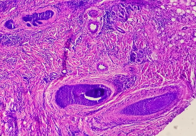 Vue microscopique du carcinome basocellulaire est un type de cancer de la peau