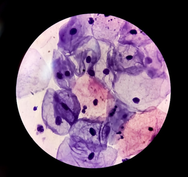 Photo vue microscopique du frottis de pap montrant des cellules du col de l'utérus humain ou des cellules épithéliales squameuses