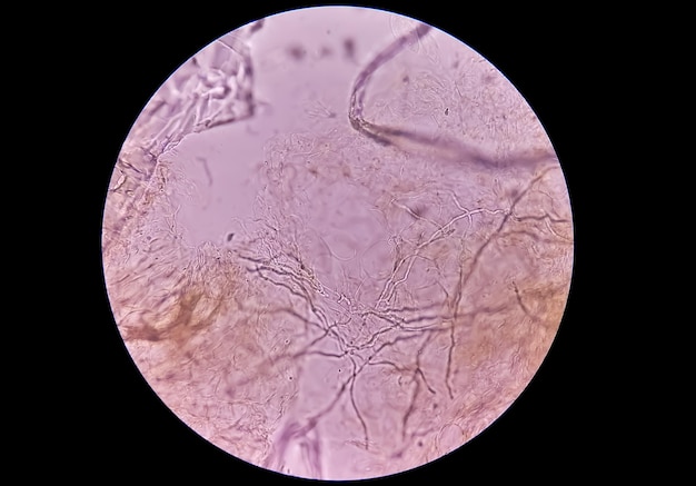 Photo vue microscopique du raclage des ongles pour le test de champignons montrant des dermatophytes