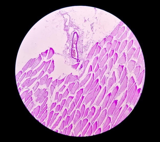 Vue microscopique de l'étude histologique des tissus montrant un rhabdomyome
