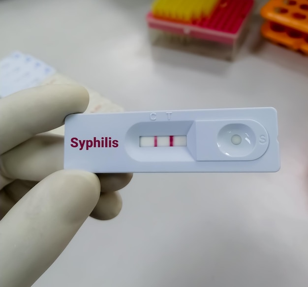 La vue rapprochée de l'appareil de la syphilis ou du test de dépistage rapide montre le résultat positif d'un patient