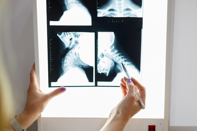 Vue rapprochée de la main du médecin avec un stylo pointant sur l'image radiographique du cou