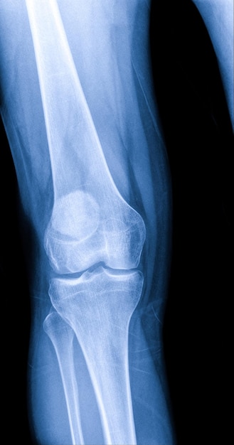 X-ray de l'articulation du genou vue AP et LATERAL fracture et déplacement de l'os de la rotule ou du genou souligné en rouge