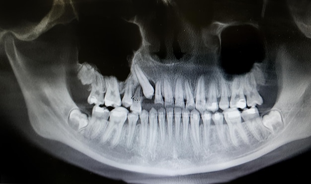 X-ray dentaire avec appareils orthopantomographiques OPG X-ray DR numérique pour les dents d'adolescents