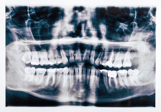 Xray scan de dents humaines douleur simulée