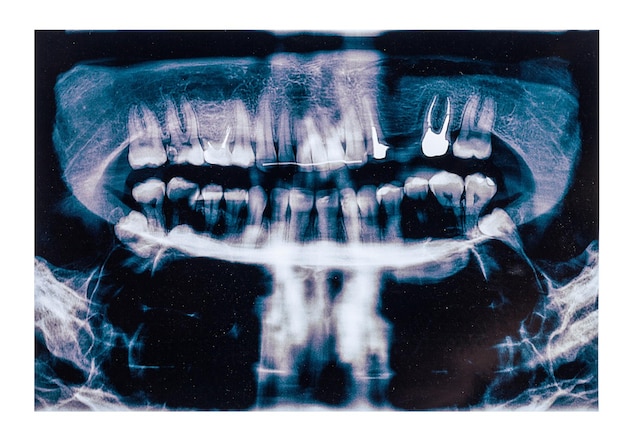 Photo xray scan de dents humaines douleur simulée