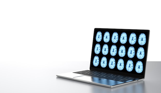 3d rendering computer notebook display x-ray brain isolated on white