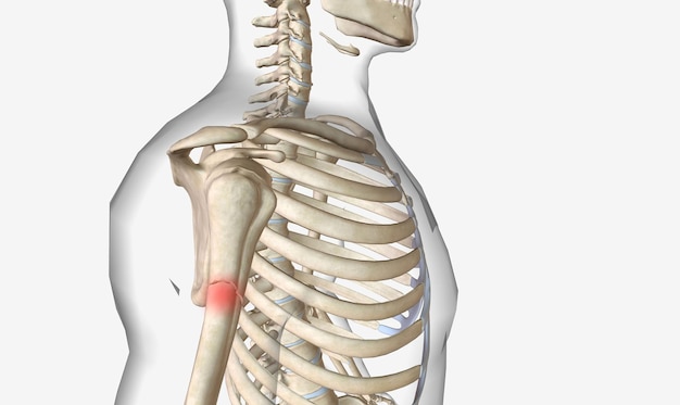 A fracture called a broken bone is an acute injury that causes a bone to break partially or completely