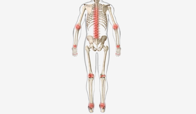 Joint Inflammation in Psoriatic Arthritis