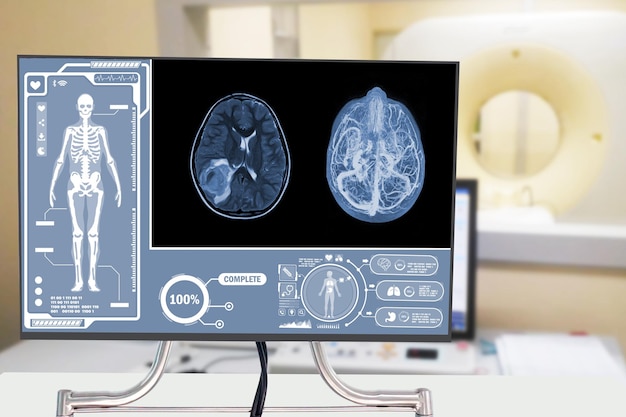 MRI OF THE BRAIN AND MRA MRV OF THE BRAIN acute parenchymal hemorrhage with small portion of subacute stage centered Medical healthcare and technology concept