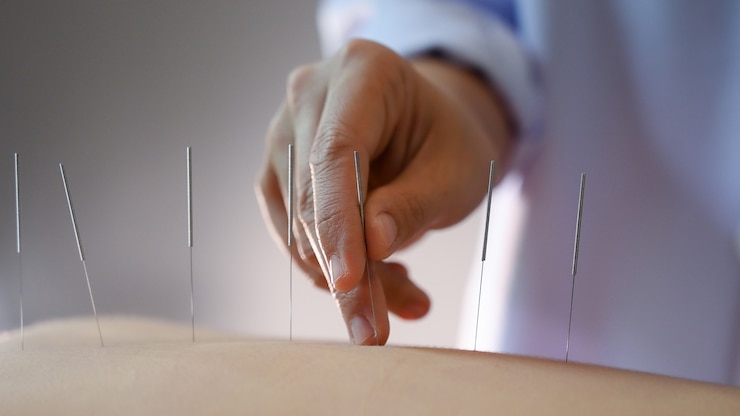 Fotoğraf acupuncture .women who are the back and acupuncture treatment at salon