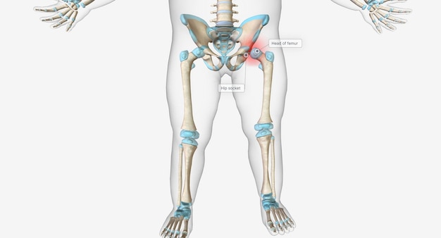 Hip dysplasia occurs when the hip socket is too shallow