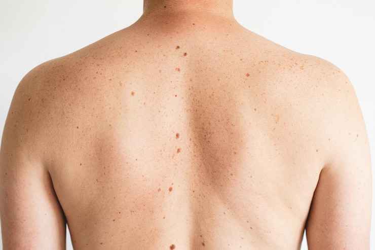 Fotoğraf pigmentation close up detail of the bare skin on a man back with scattered moles and freckles