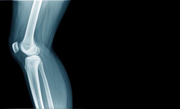 Xray image og knee joint in blue tone with copy space