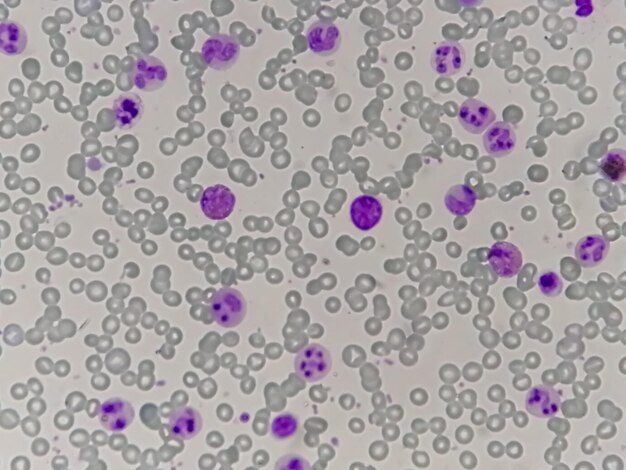 100x vergroting van chronische myelocytische leukemie of CML met chronische fase