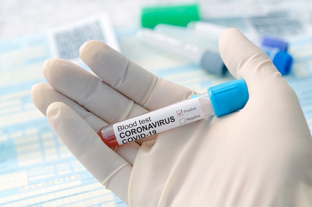 2019-nCoV Coronavirus afkomstig uit Wuhan, China. Coronavirus bloedonderzoek concept. Dokter dient medische handschoen in met reageerbuis met Coronavirus positief bloed over laboratoriumbureau.