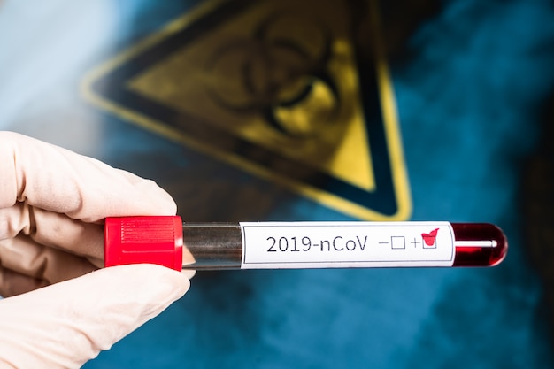 2019-nCoV. De arts houdt een reageerbuis met bloed in zijn hand. Een positieve bloedtest voor een nieuw coronavirus.