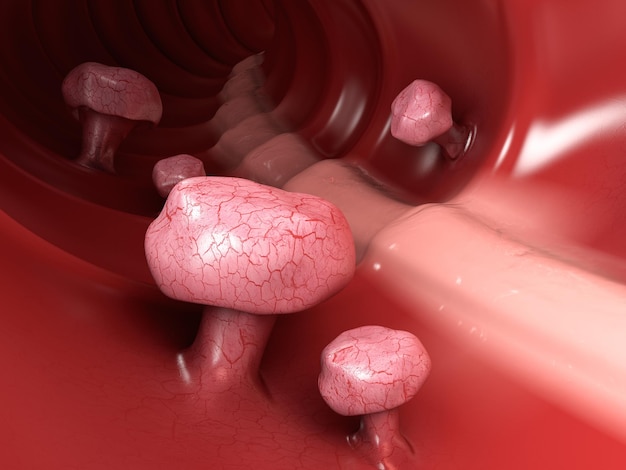 Foto illustrazione 3d dei polipi del colon. polipo nell'intestino. bianco isolato.