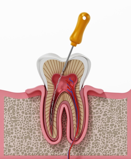 Photo 3d illustration of root canal treatment process