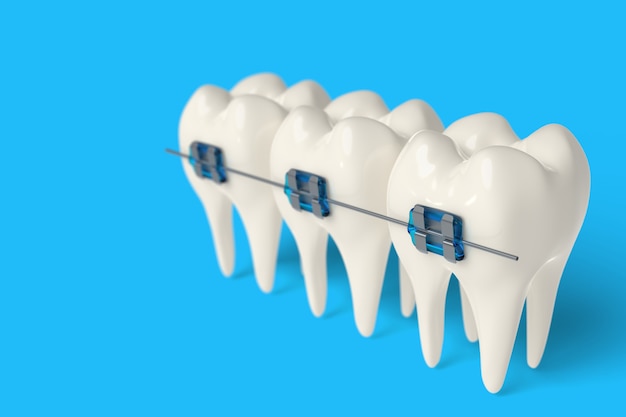 3d render tooth with ceramic and metal braces in gums