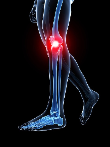 Photo 3d rendered medical illustration painful knee