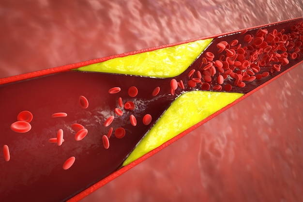 3D-rendering atherosclerose met cholesterolbloed of plaque in vat oorzaak van coronaire hartziekte