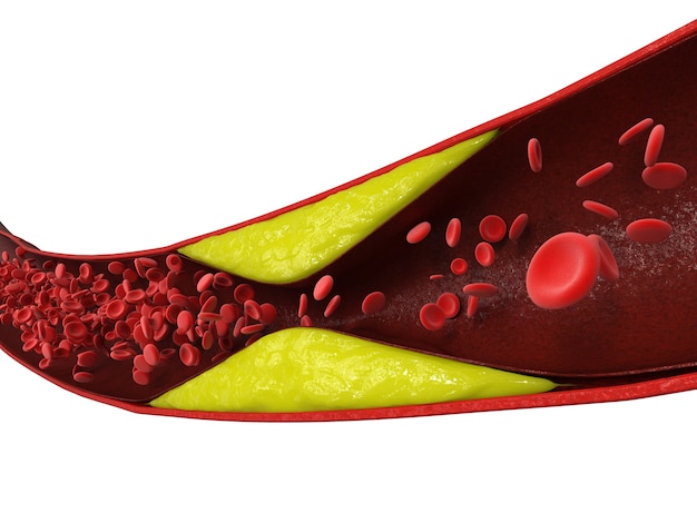 Photo 3d rendering atherosclerosis with cholesterol blood or plaque in vessel cause of coronary artery disease