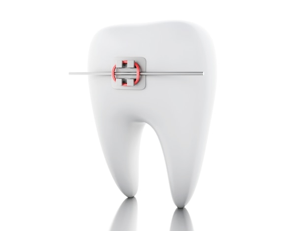 3D Tooth with braces.