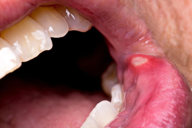 Photo 4k ultra hd closeup image of tongue with canker sores oral health awareness