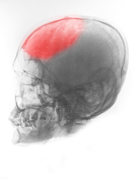 写真 脳の赤い領域を示す人間の頭蓋骨の拡大図。