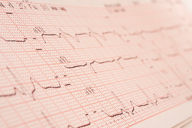 Фото Кусок электрокардиограммы крупным планом. выборочный фокус, тонированное изображение