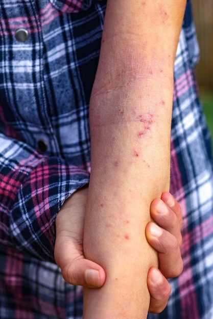 A verwondt atopische dermatitis in de handen van een kind