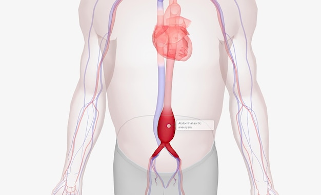 写真 腹部大動脈瘤は、動脈の壁が弱くなったために腹部大動脈が膨らんだときに発生します