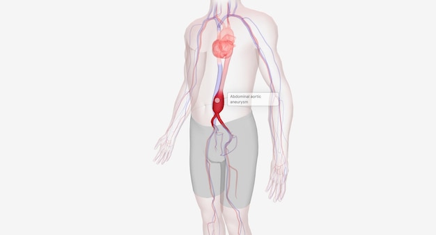 写真 腹部大動脈瘤は、動脈の壁が弱くなったために腹部大動脈が膨らんだときに発生します