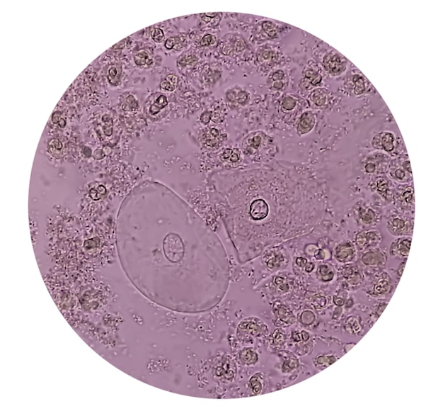 Abnormal microscopic urine analysis in laboratory