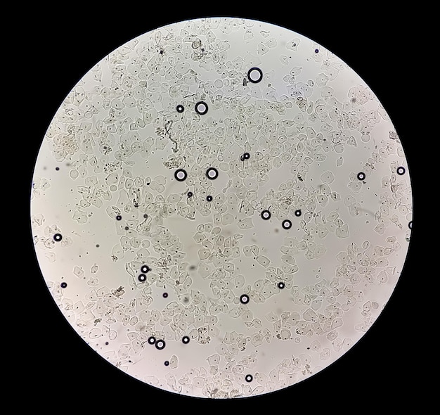 사진 많은 상피세포와 적혈구를 보여주는 현미경에 의한 요검사 결과 이상